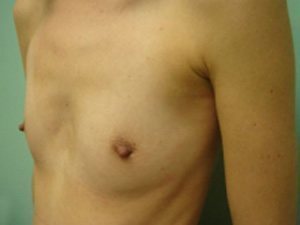 Breast Augmentation Before & After case 10