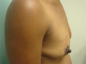 Breast Augmentation Before & After case 11