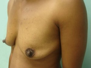 Breast Augmentation Before & After case 11