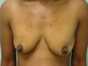 Breast Augmentation Before & After case 11