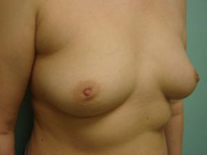 Breast Augmentation Before & After case 12