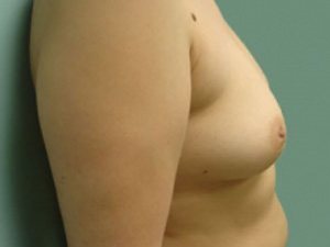 Breast Augmentation Before & After case 12