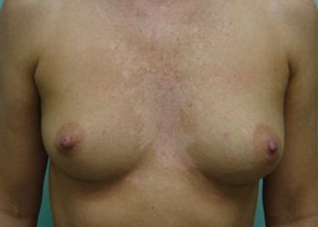 Breast Augmentation Before & After case 13