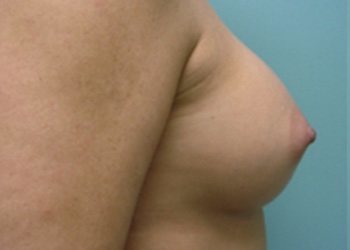 Breast Augmentation Before & After case 13