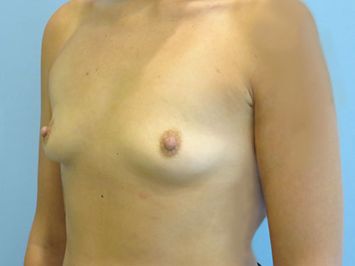 Breast Augmentation Before & After case 14
