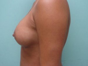 Breast Augmentation Before & After case 16