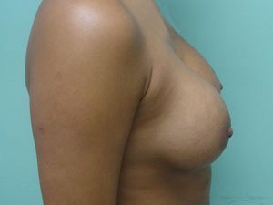 Breast Augmentation Before & After case 16
