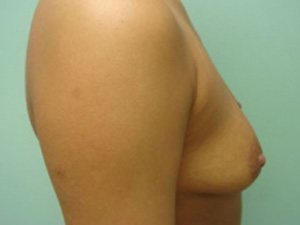 Breast Augmentation Before & After case 16