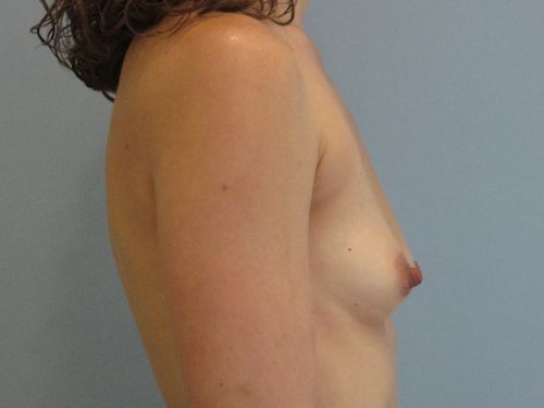 Breast Augmentation Before & After case 1