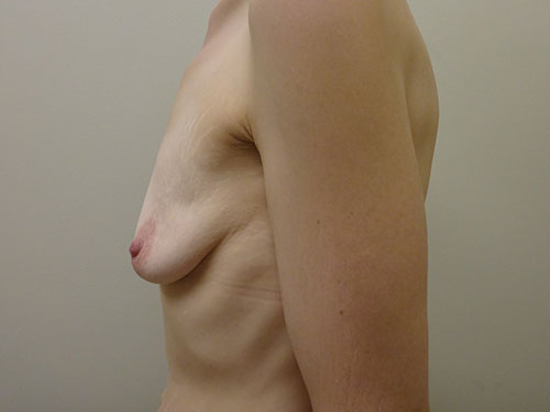 Breast Augmentation Before & After case 2