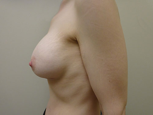 Breast Augmentation Before & After case 2