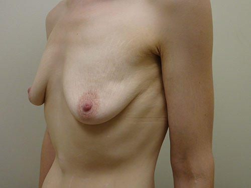 Breast Augmentation Before & After case 2