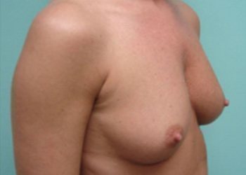 Breast Augmentation Before & After case 3