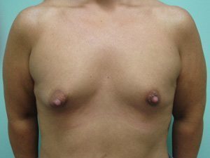 Breast Augmentation Before & After case 4