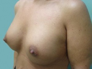 Breast Augmentation Before & After case 4