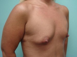 Breast Augmentation Before & After case 4
