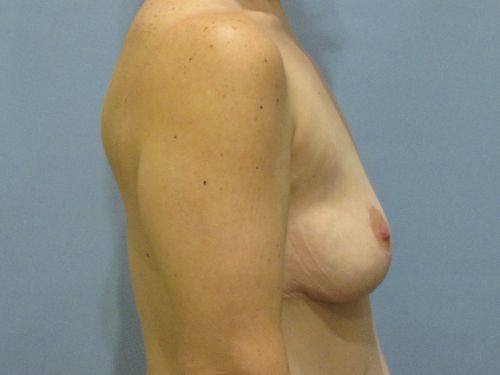 Breast Augmentation Before & After case 5