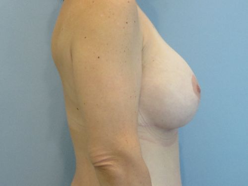 Breast Augmentation Before & After case 5