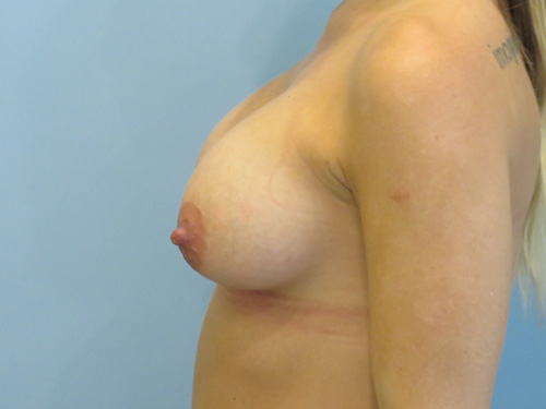 Breast Augmentation Before & After case 7