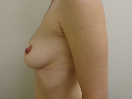 Breast Augmentation Before & After case 8