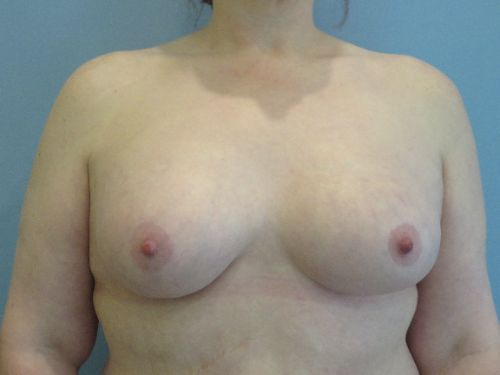 Breast Augmentation Before & After case 9
