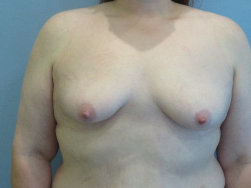Breast Augmentation Before & After case 9