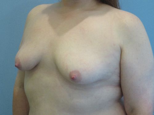 Breast Augmentation Before & After case 9