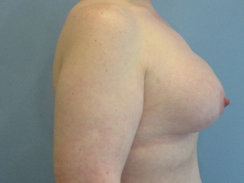 Breast Augmentation Before & After case 9