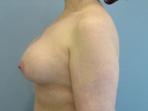 Breast Augmentation Before & After case 9