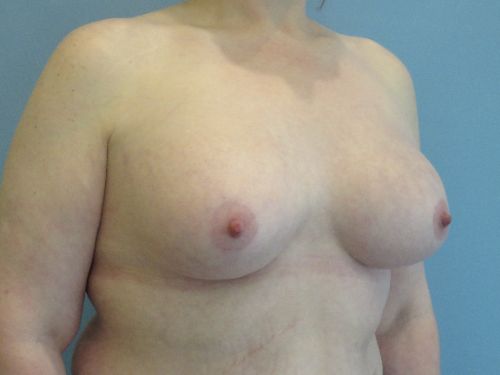 Breast Augmentation Before & After case 9