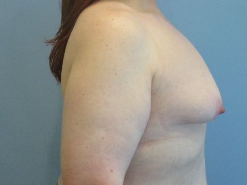 Breast Augmentation Before & After case 9