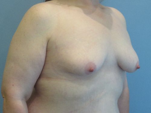 Breast Augmentation Before & After case 9