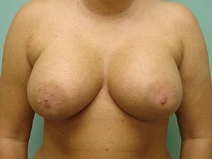 Breast Augmentation Before and After case 15