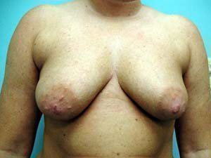 Breast Augmentation Before and After case 15