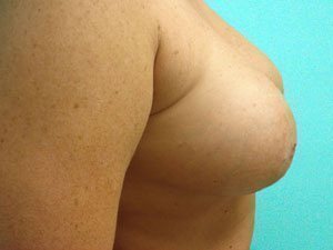 Breast Augmentation Before and After case 15