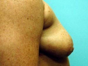 Breast Augmentation Before and After case 15
