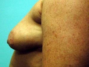 Breast Augmentation Before and After case 15