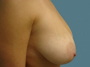 Breast Lift Before & After case 1