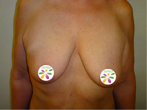 Breast Lift Before & After case 3