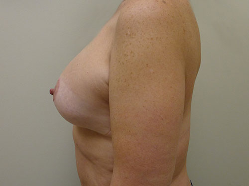 Breast Lift Before & After case 3