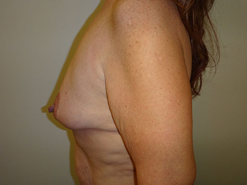 Breast Lift Before & After case 3