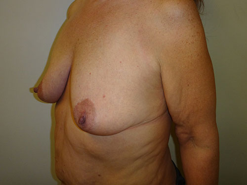 Breast Lift Before & After case 3