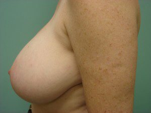 Breast Lift Before and After case 4