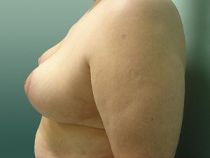 Breast Reduction Before and After Case 5
