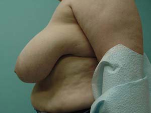 Breast Reduction Before and After Case 5