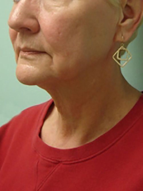 Facelift | Neck Lift Before & After