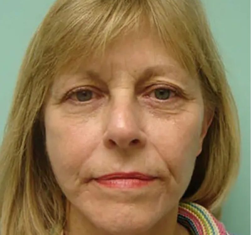 Facelift | Neck Lift Before & After case 3