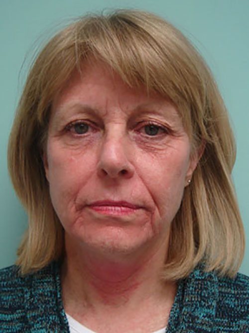 Facelift | Neck Lift Before & After case 3