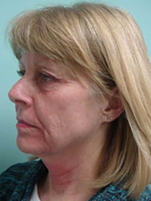 Facelift | Neck Lift Before & After case 3