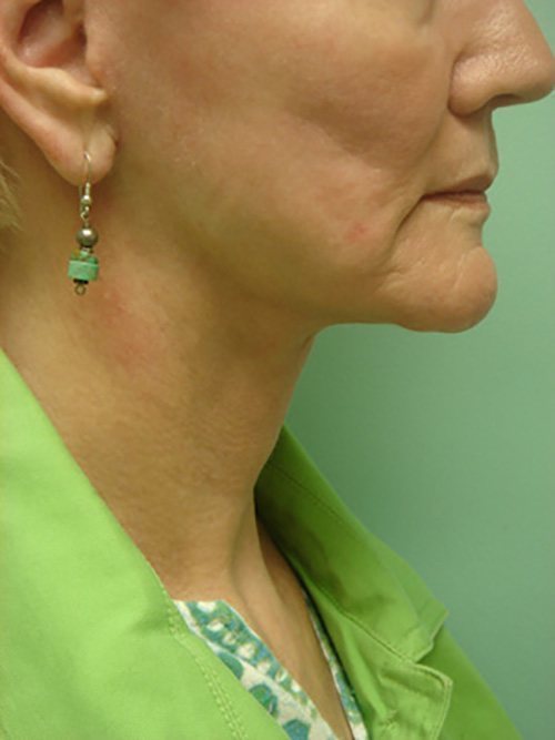 Facelift | Neck Lift Before and After case 1